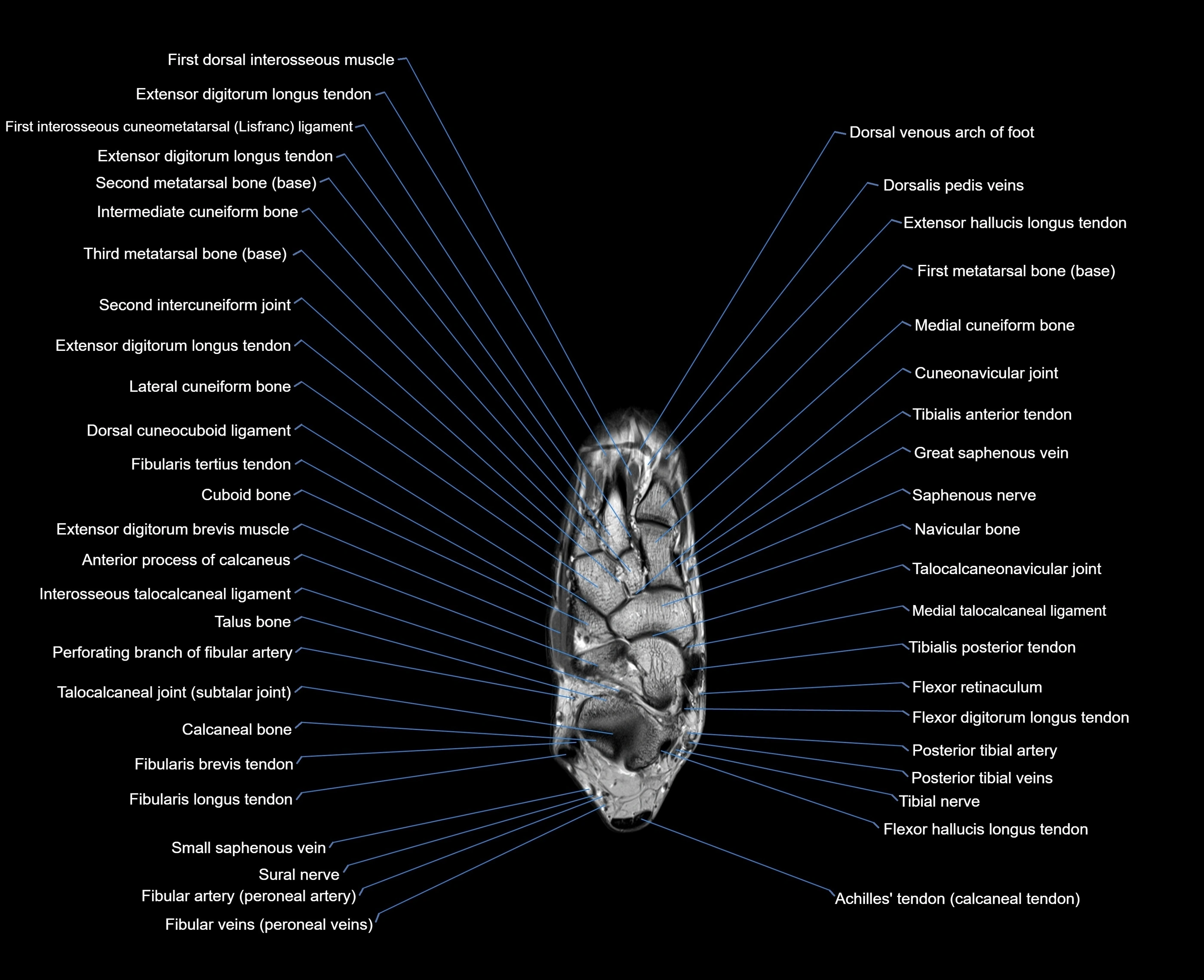 MRI foot coronal cross sectional anatomy 3T  radiology  image-img-00001-00015.webp